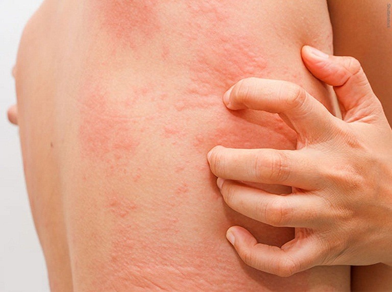 Nổi mề đay, mẩn ngứa trên da là triệu chứng mà những hầu hết người nhiễm biến chủng Omicron đang gặp phải
