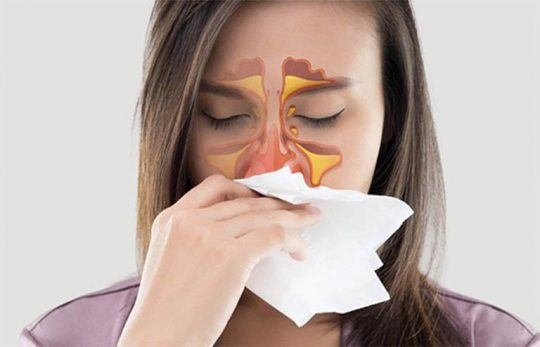 Viêm mũi xuất tiết là tình trạng xuất hiện dịch nhầy trong mũi và họng người bệnh