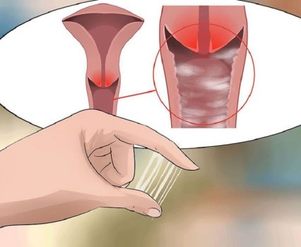 Viêm âm đạo ra mủ là gì?