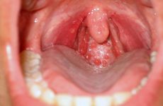 Viêm họng hạt là thể bệnh phát triển của viêm họng mãn tính