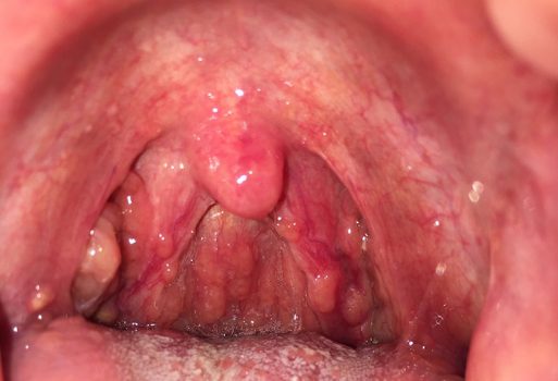 Viêm họng hạt ở lưỡi là một thể bệnh của viêm họng, gây nhiều phiền toái, khó chịu cho bệnh nhân