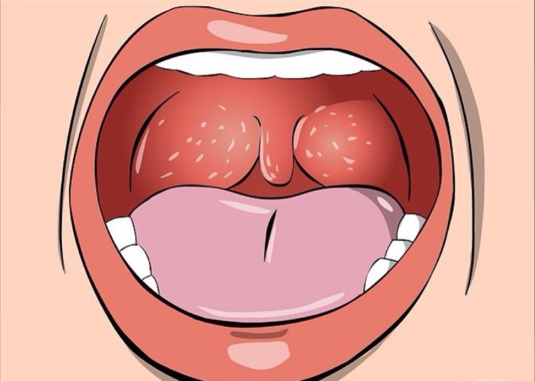 Bệnh viêm họng là tình trạng niêm mạc họng bị tổn thương, gây sưng tấy