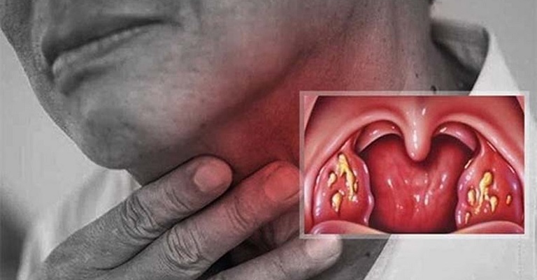 Viêm họng liên cầu khiến người bệnh đau nhức, nóng rát vòm họng