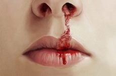 Viêm xoang chảy máu mũi là triệu chứng không thể chủ quan