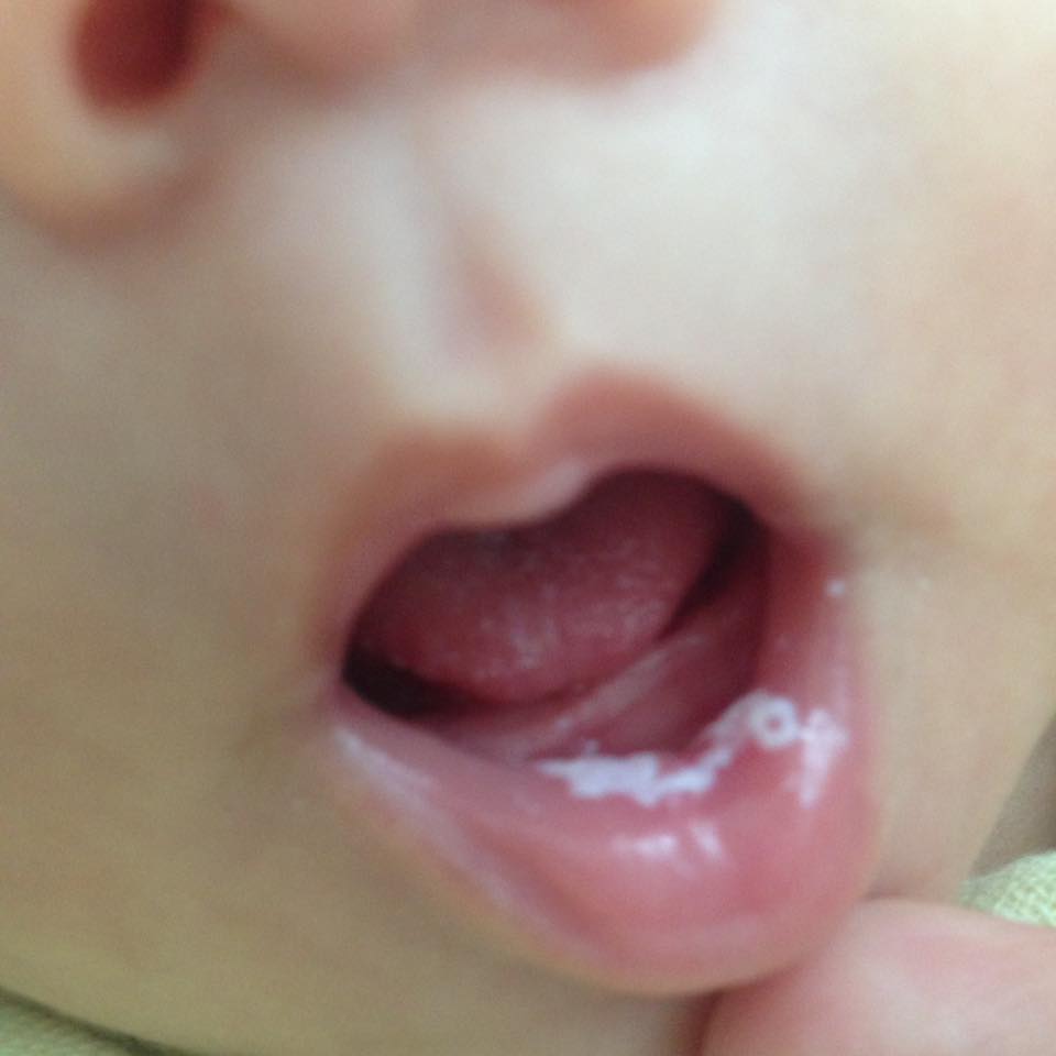 Hiện tượng nấm miệng ở trẻ, cha mẹ chú ý cần điều trị sớm 