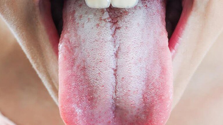 Lưỡi trắng và nhạt miệng là bệnh gì?