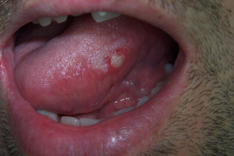 Mụn nhọt gây lở loét trên lưỡi mãi không khỏi có thể là dấu hiệu của ung thư lưỡi
