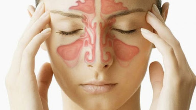 Viêm xoang mũi dị ứng là tổn thương tại các xoang mũi do nguyên nhân từ các yếu tố dị ứng