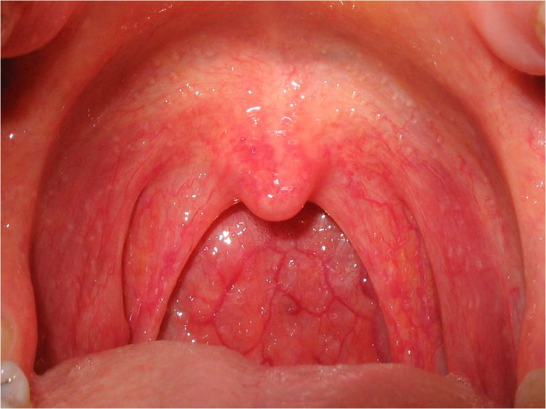 Viêm họng là biến chứng nguy hiểm của viêm xoang hàm