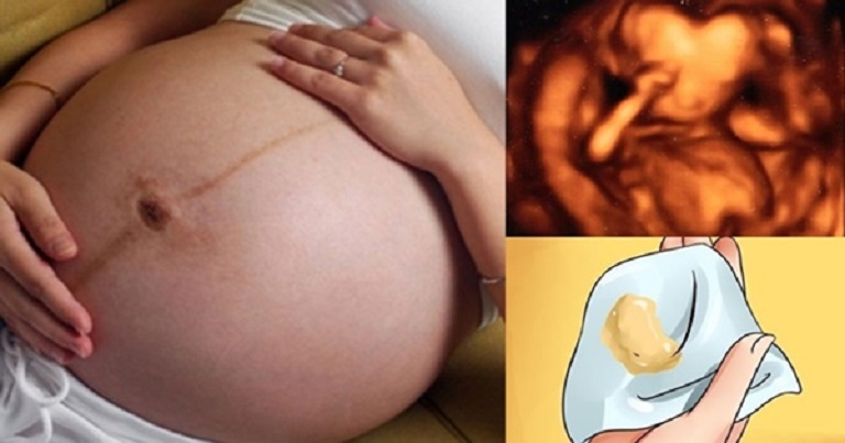 Nếu chị em bị viêm lộ tuyến khi mang thai sẽ được khuyến nghị sinh mổ để đảm bảo an toàn cho thai nhi