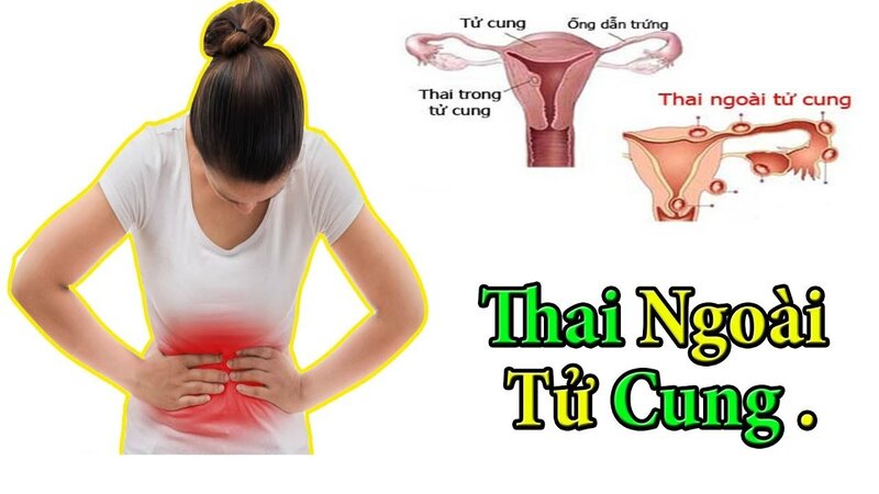Thai ngoài tử cung là bệnh lý không hiếm gặp, chị em cần lưu ý