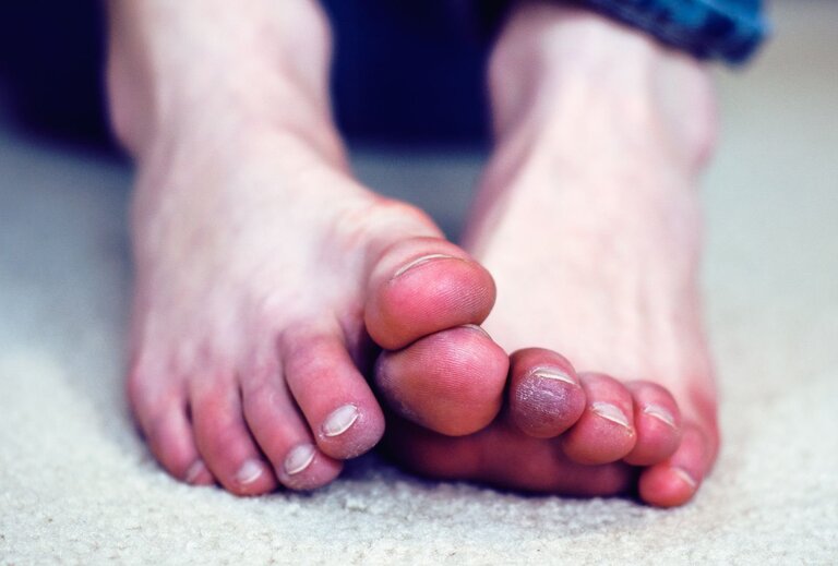  Đau mu bàn chân là dấu hiệu bệnh gì? Chữa thế nào hiệu quả? [XEM NGAY]