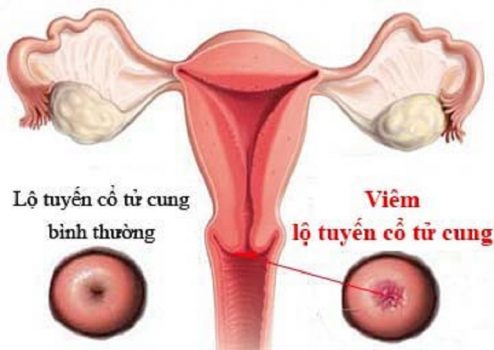 Viêm lộ tuyến cổ tử cung được xem là căn bệnh nguy hiểm hàng đầu hiện nay