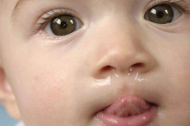 Dấu hiệu nhận biết viêm họng xuất tiết cơ bản nhất ở trẻ em đó là chảy nhiều nước mũi