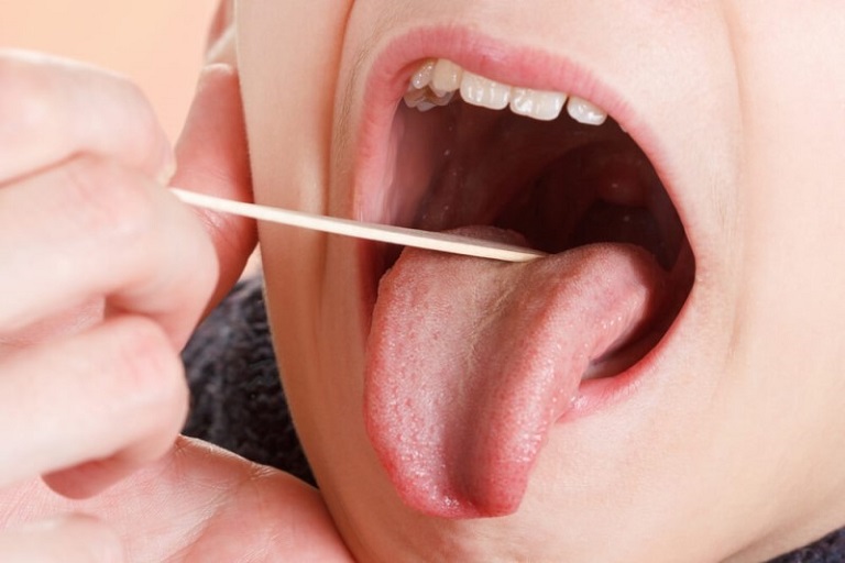 Viêm họng nổi hạch trên thực tế chỉ được xem là một trong rất nhiều các biểu hiện khác của bệnh viêm họng