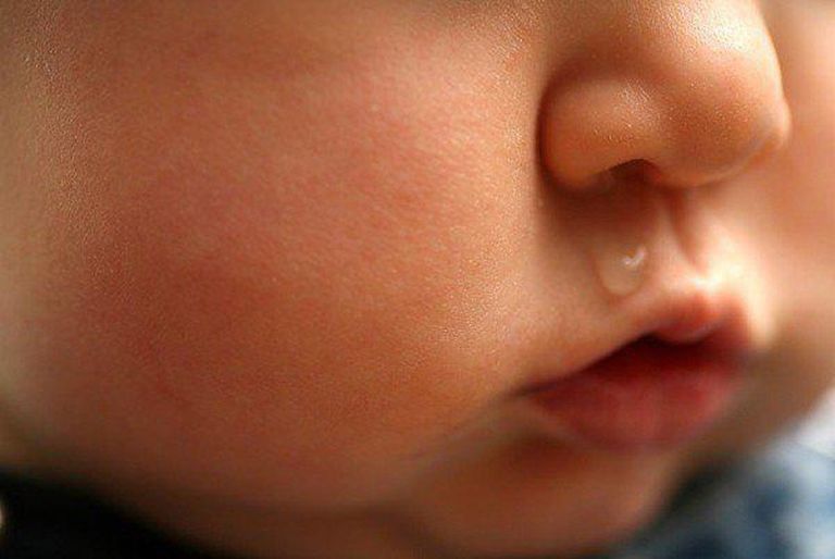 Viêm mũi dị ứng ở trẻ sơ sinh gây ra nhiều hậu quả cho bệnh nhi