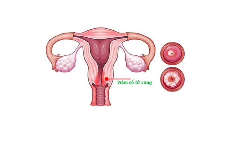 Viêm cổ tử cung là một trong những bệnh lý phụ khoa không hiếm gặp