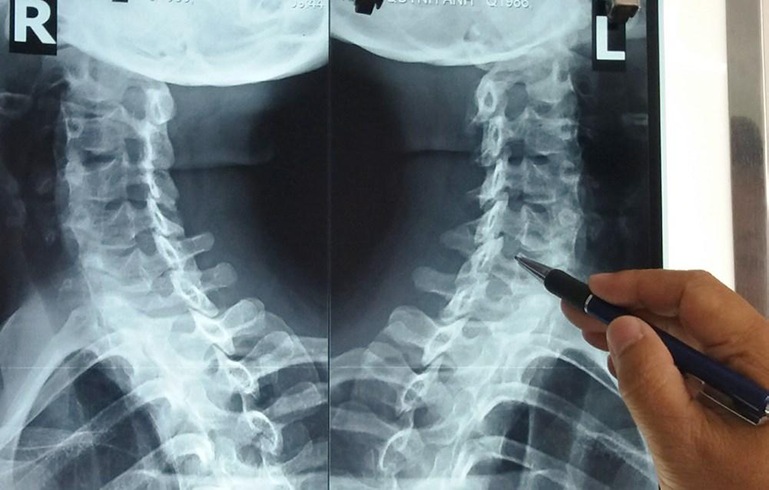 Phim chụp X-quang thoái hoá cột sống