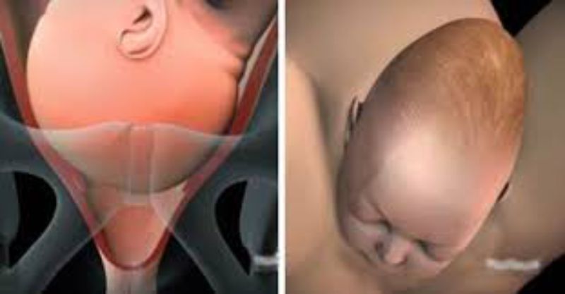 Giãn nỡ xương chậu khi sinh là nguyên nhân gây đau khớp háng
