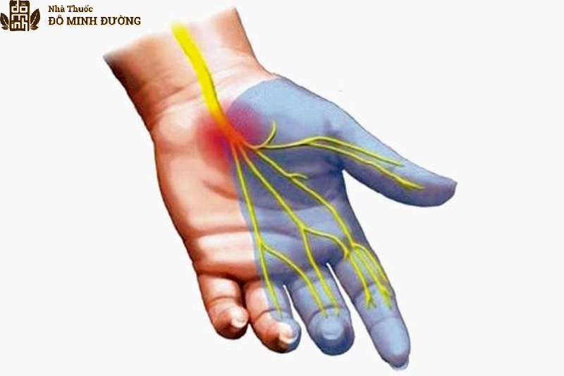 Hội chứng ống cổ tay là nguyên nhân gây viêm đau nhức cổ tay