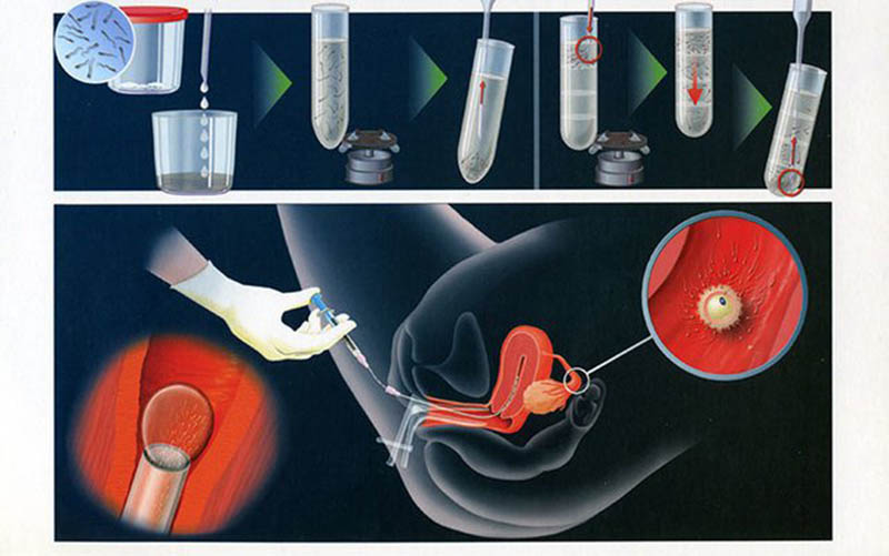 Thụ tinh nhân tạo dùng tinh trùng của nam giới bơm vào tử cung của người nữ để tăng khả năng đậu thai