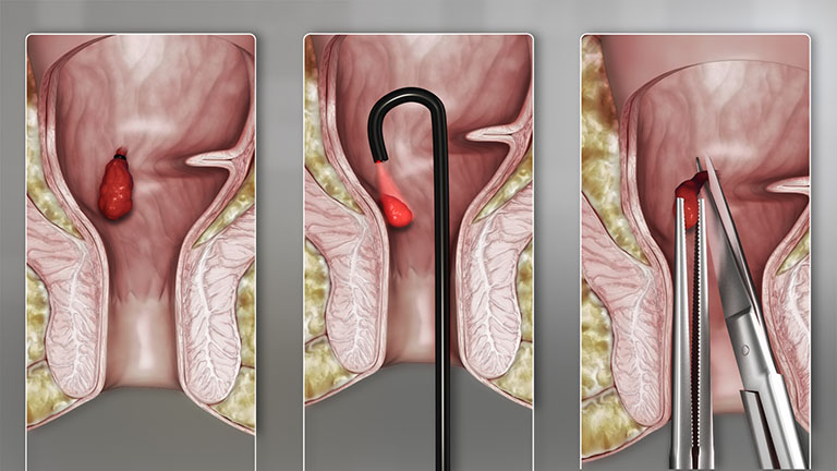 Cắt bỏ trĩ (hemorrhoidectomy)