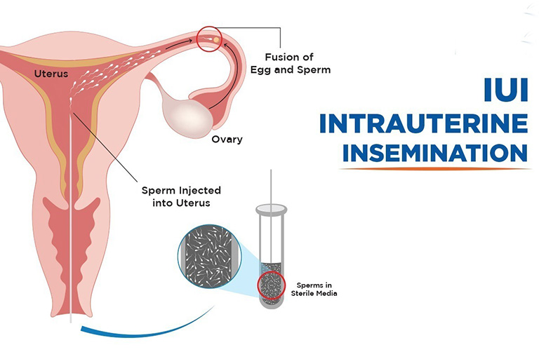 Bơm tinh trùng vào buồng tử cung (IUI)
