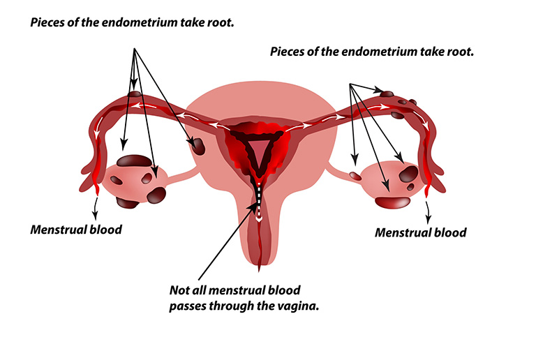 Kinh nguyệt ngược dòng gây lạc nội mạc tử cung