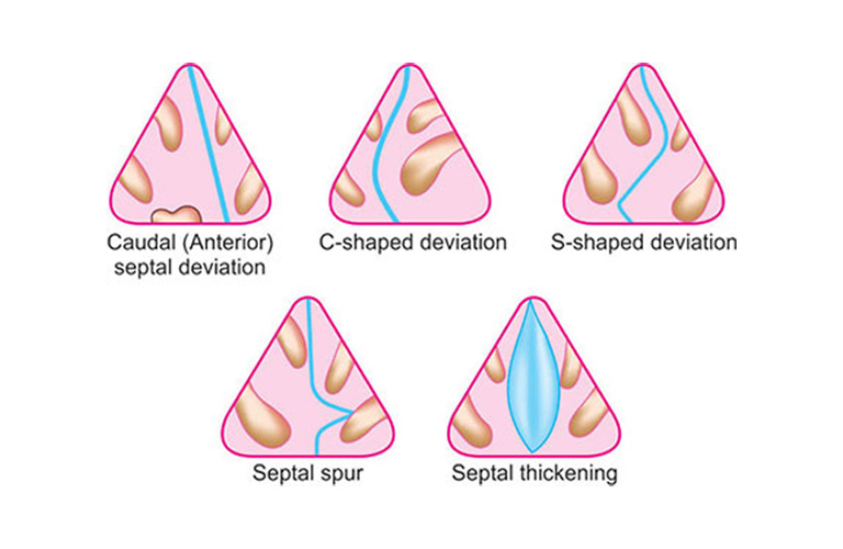 Lệch vách ngăn mũi được phân thành nhiều dạng