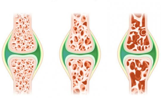 Osteoporosis stages. severe osteoporosis