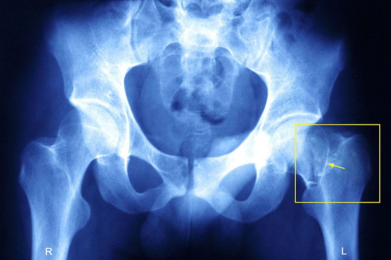 Loãng xương thường gây gãy xương hông