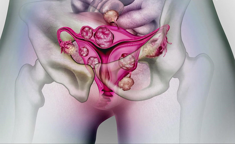 U xơ tử cung được phân thành nhiều loại dựa vào vị trí của khối u