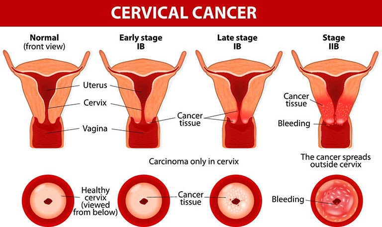 Bệnh ung thư cổ tử cung được phân thành 4 giai đoạn 