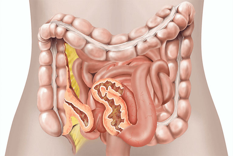 Bệnh Crohn