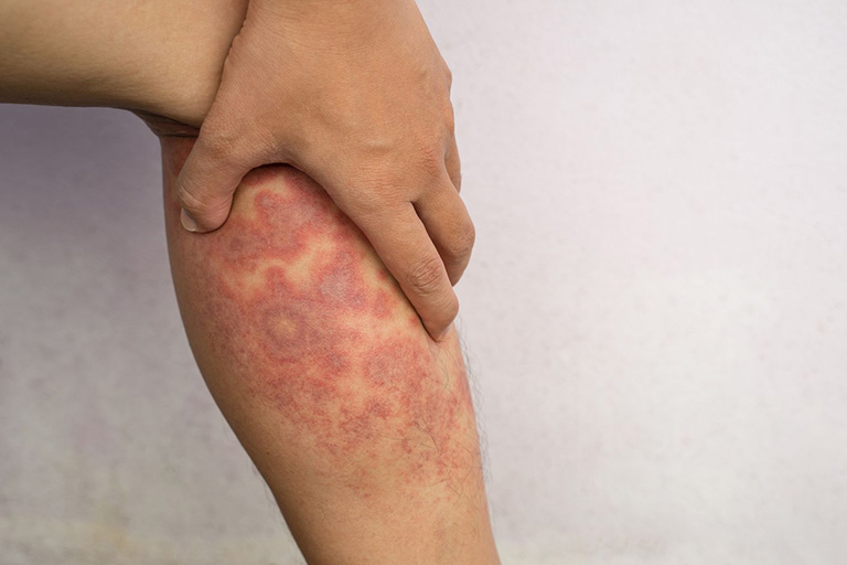 Bệnh chàm (Eczema)