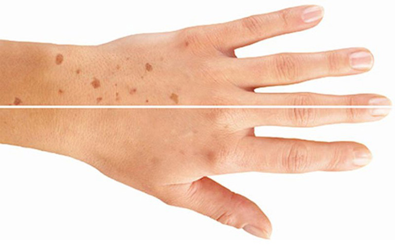 Những mảng da tối màu có kích thước nhỏ thường tập trung ở mặt, tay