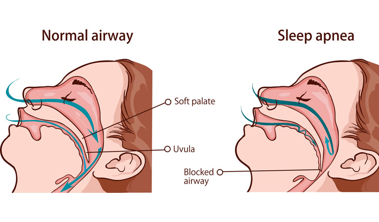 Hội chứng ngưng thở khi ngủ do tắc nghẽn (OSA)