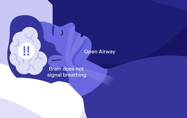 Chứng ngưng thở khi ngủ trung ương (CSA)