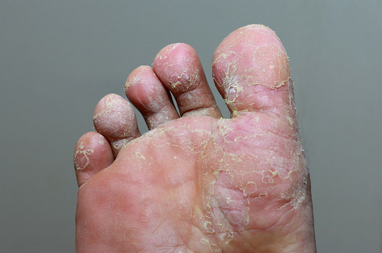 Bệnh nấm da chân