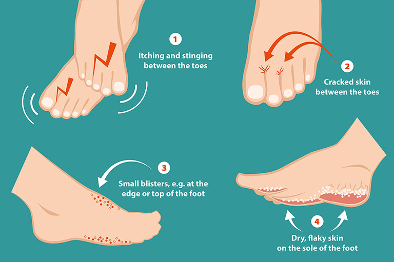 Bệnh nấm da chân gây viêm ngứa, tiết dịch và đóng vảy ở giữa ngón chân