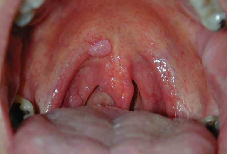 Ung thư vòm họng giai đoạn II