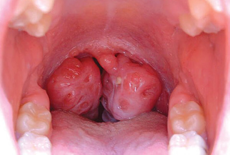 Ung thư vòm họng giai đoạn IV