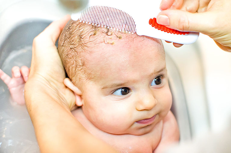Xử lý nắp nôi cho trẻ sơ sinh bằng bàn chảy lông mềm hoặc lược và dầu gội đầu