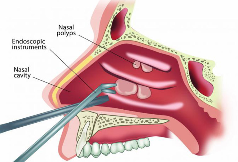 Phẫu thuật loại bỏ polyp mũi