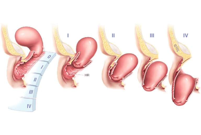 Sa tử cung được phân thành 4 cấp độ dựa vào mức độ sa ra ngoài của tử cung