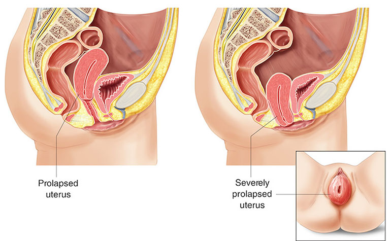 Cảm thấy hoặc nhìn thấy mô tử cung phình ra khỏi âm đạo