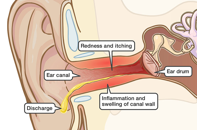Viêm màng nhĩ thường do nhiễm trùng lây lan từ viêm tai ngoài
