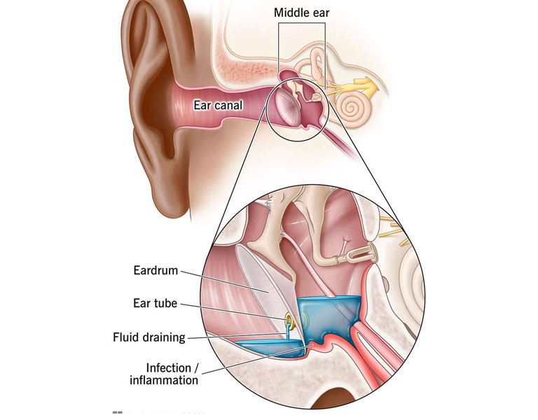Phẫu thuật mở ống thông tai