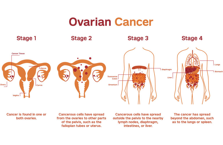 Bệnh ung thư buồng trứng có bốn giai đoạn