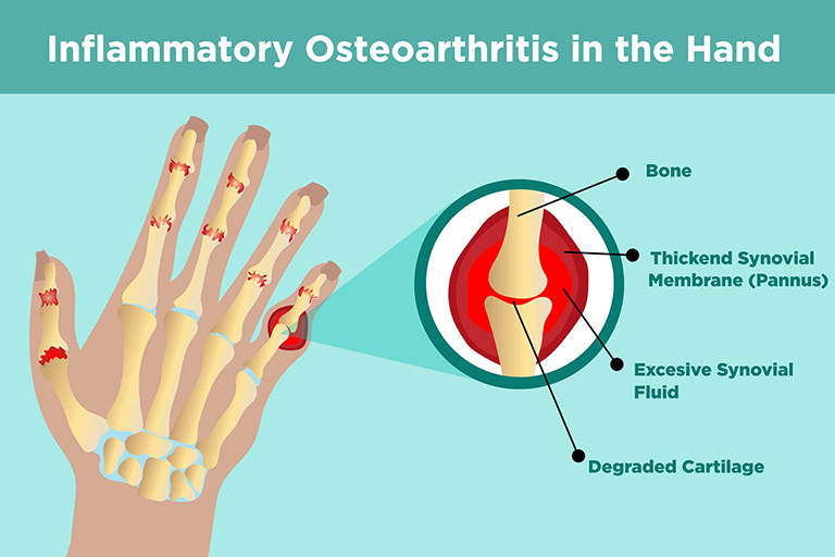Bệnh viêm xương khớp (OA) ở ngón tay và bàn tay